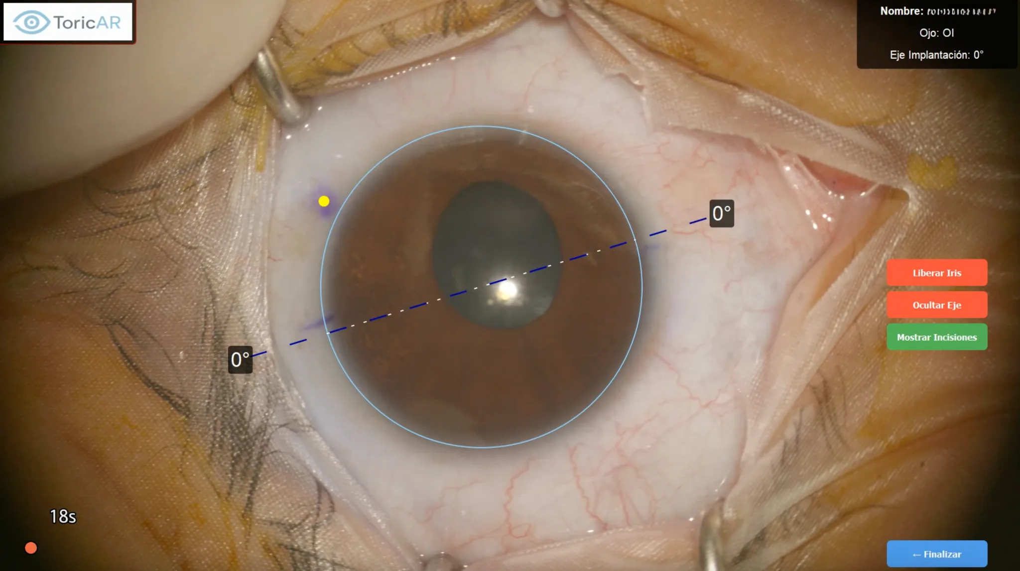 ToricAR en cirugía: eje tórico proyectado sobre el ojo en tiempo real (1/9)